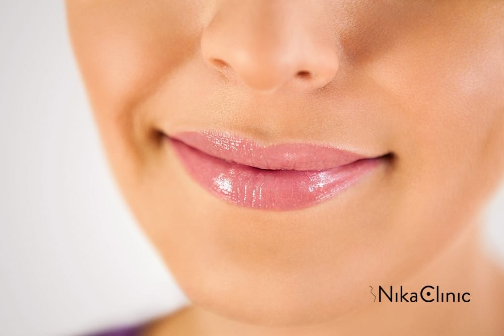 Filler labbra a Milano dello studio Nika Clinic