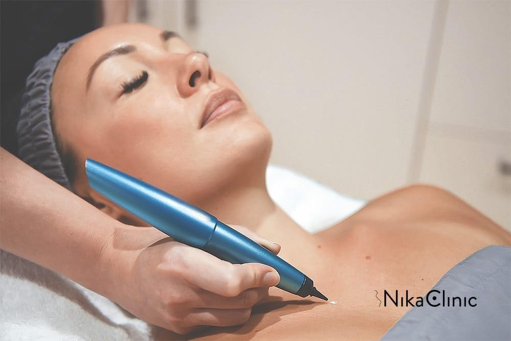 Cryopen a Milano presso Nika Clinic.