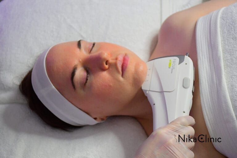 HIFU lifting non chirurgico per il viso e décolleté presso la Nika Clinic a Milano.