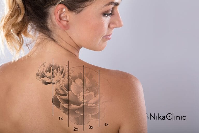 Rimozione tatuaggi con laser eseguito da Nika Clinic a Milano