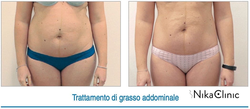 Trattamento di criolipolisi per adolescenti presso Nika Clinic a Milano.