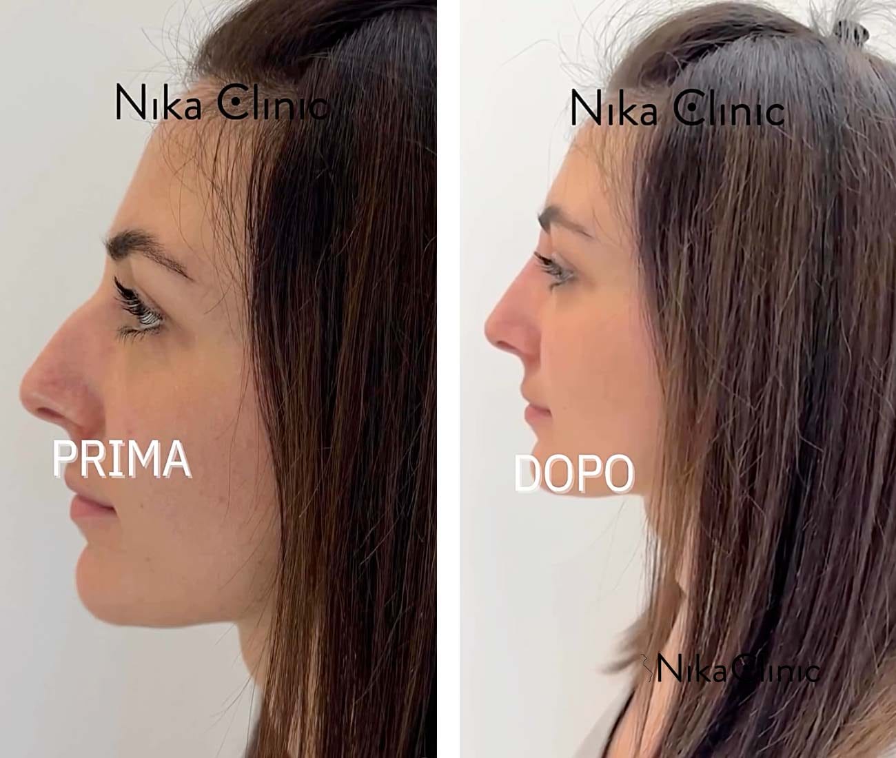 Confronto affiancato del profilo di una donna prima ("PRIMA") e dopo ("DOPO") un intervento di rinofiller presso la clinica Nika di Milano, che evidenzia i cambiamenti nella forma del suo naso.
