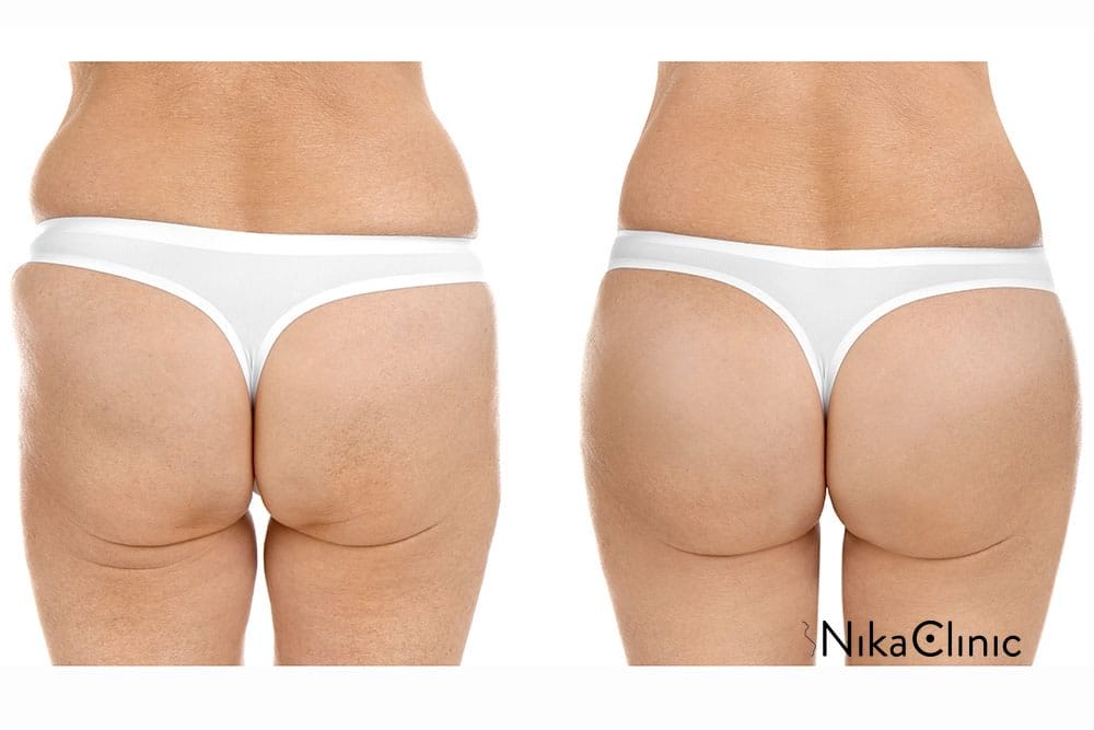Osserva la trasformazione dei glutei di una donna prima e dopo il trattamento di criolipolisi alla Nika Clinic a Milano