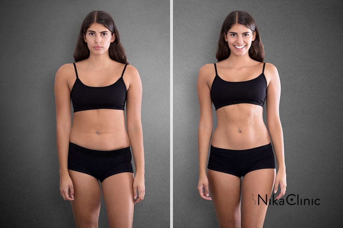 Una donna sottoposta a criolipolisi, un trattamento non invasivo per eliminare il grasso in eccesso, ottenendo risultati apprezzabili indossando biancheria intima nera.