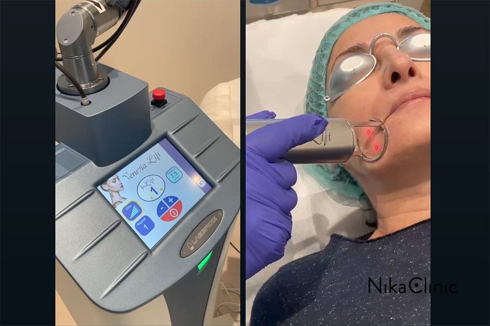 Trattamento estetico Venezia Lift con un paziente che riceve una terapia della pelle del viso per la riduzione delle piccole rughe tramite un dispositivo laser alla Nika Clinic a Milano.