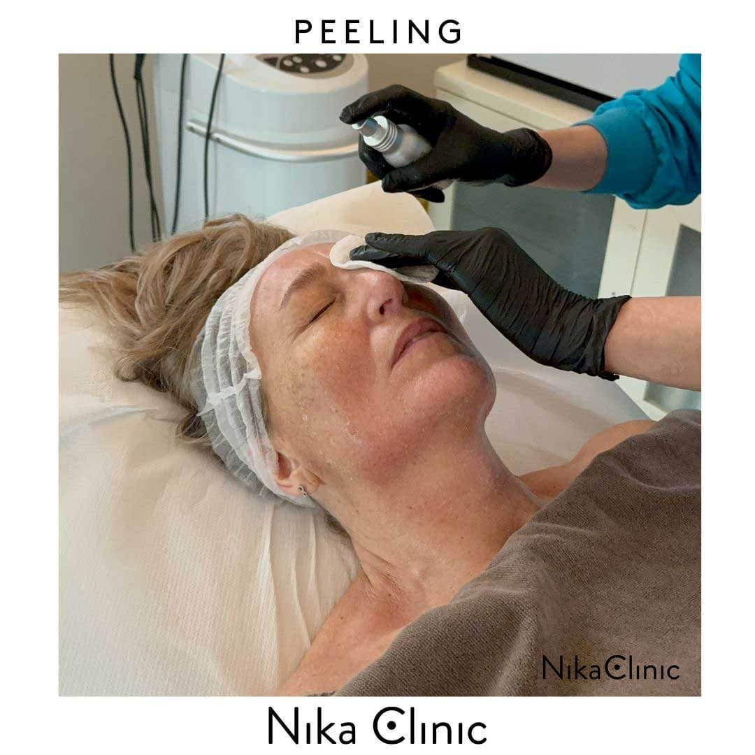 Una persona con una cuffia per capelli e un asciugamano è sdraiata su un lettino da clinica mentre un professionista con i guanti le applica un prodotto sul viso. Le scritte "Peeling Viso" e "Nika Clinic" sono visualizzate sull'immagine, a sottolineare la loro competenza in cura pelle.