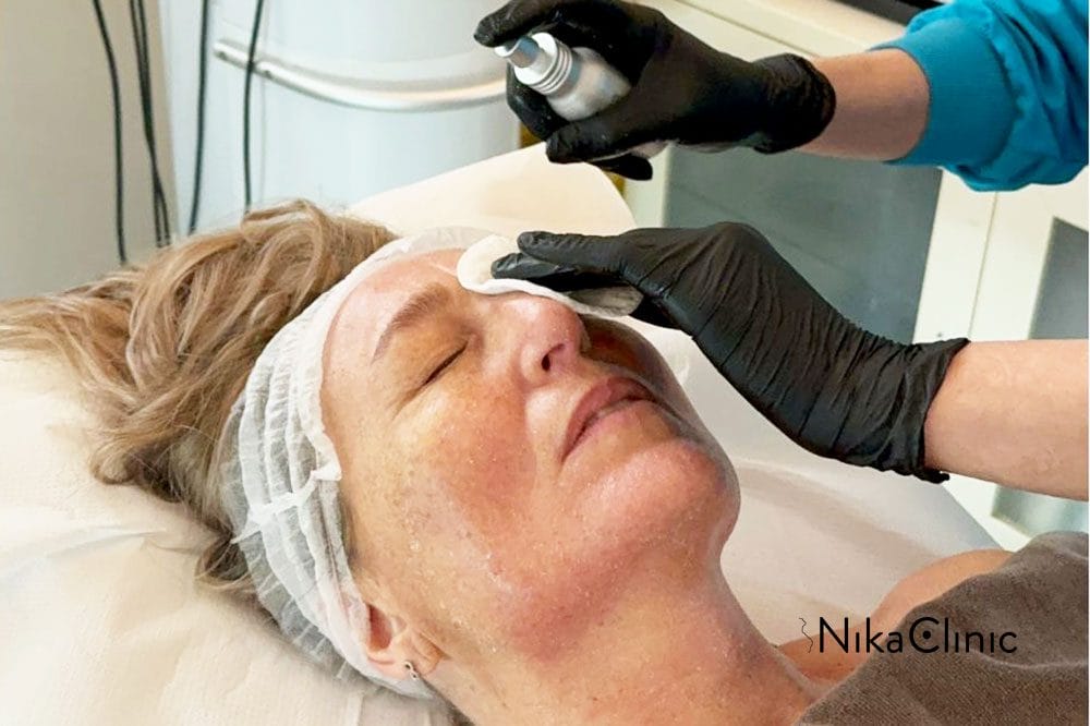 Una persona che riceve un trattamento peeling viso a Milano presso la clinica estetica Nika Clinic.