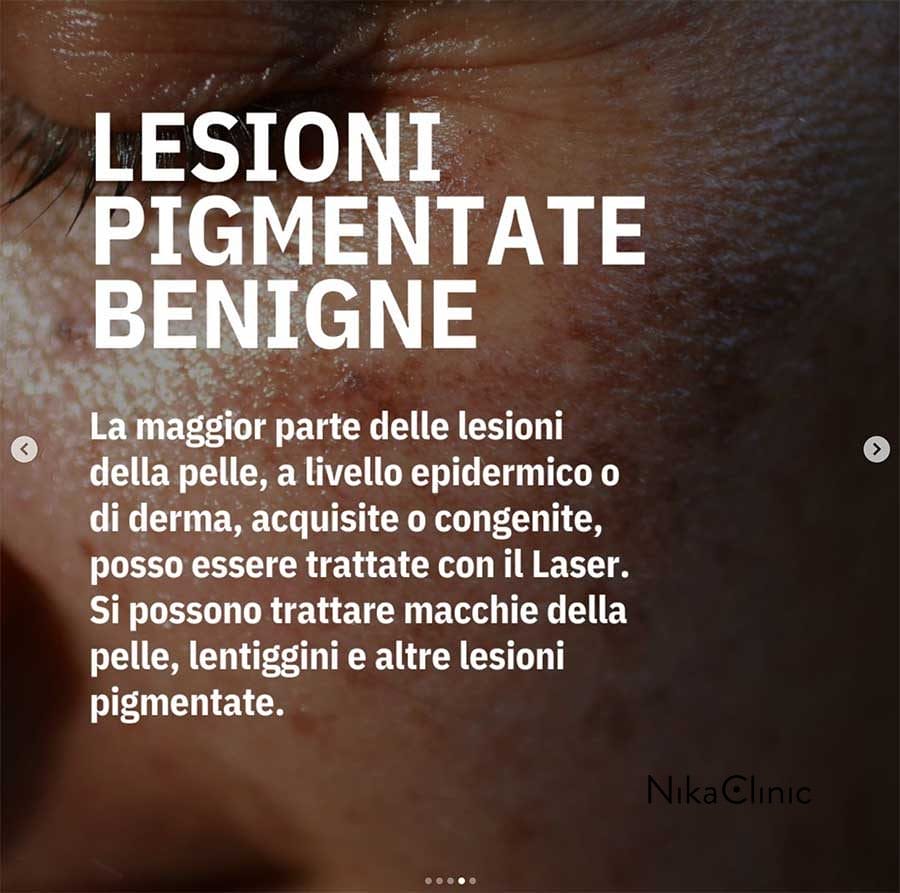 Primo piano della pelle con sovrapposizione di testo in italiano sui Trattamenti Medici per lesioni cutanee pigmentate benigne mediante laser, tra cui lentiggini e altre macchie pigmentate.
