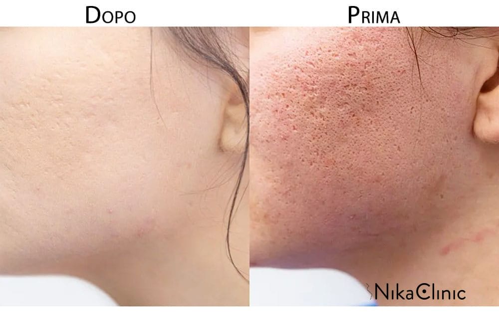 Confronto affiancato delle guance di una persona: un'immagine mostra cicatrici da acne e macchie etichettate "Prima", mentre l'altra, contrassegnata "Dopo", rivela gli effetti trasformativi del trattamento di riempimento mirato con filler sull'acne cicatriziale.