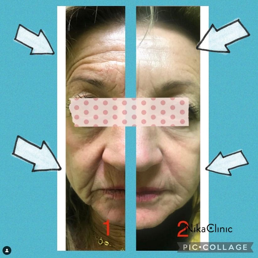 Confronto affiancato del viso di una donna prima e dopo un trattamento di riempimento cosmetico, con frecce bianche e nastro adesivo a pois che coprono gli occhi. Confronto affiancato del viso di una donna prima e dopo un trattamento di riempimento cosmetico, con frecce bianche e nastro adesivo a pois che coprono gli occhi.