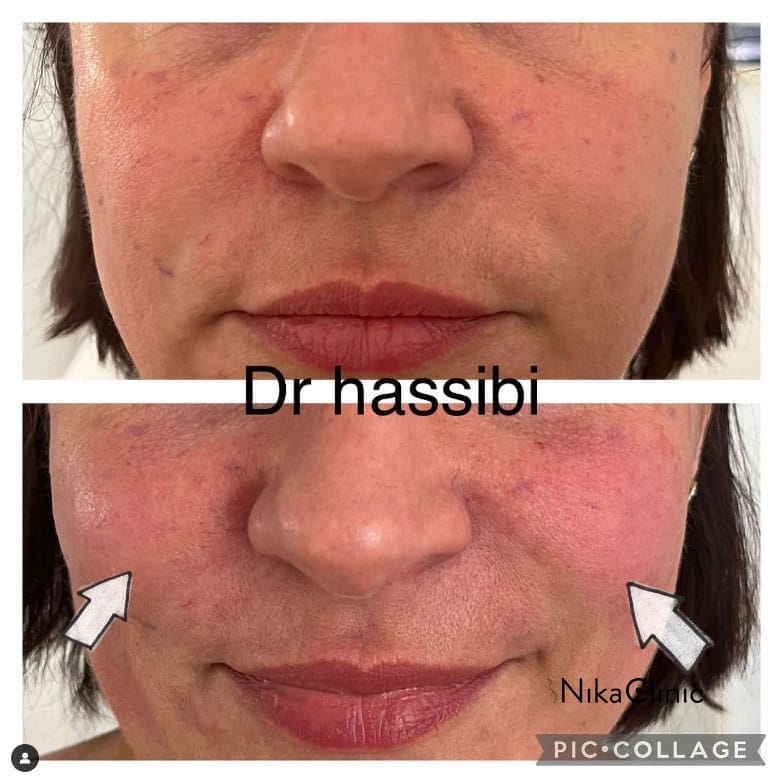 Un primo piano mostra gli straordinari risultati prima e dopo un trattamento per la pelle, con le frecce che evidenziano il volume aumentato, in particolare intorno allo zigomi. Un primo piano mostra gli straordinari risultati prima e dopo un trattamento per la pelle, con le frecce che evidenziano il volume aumentato, in particolare intorno allo zigomi.