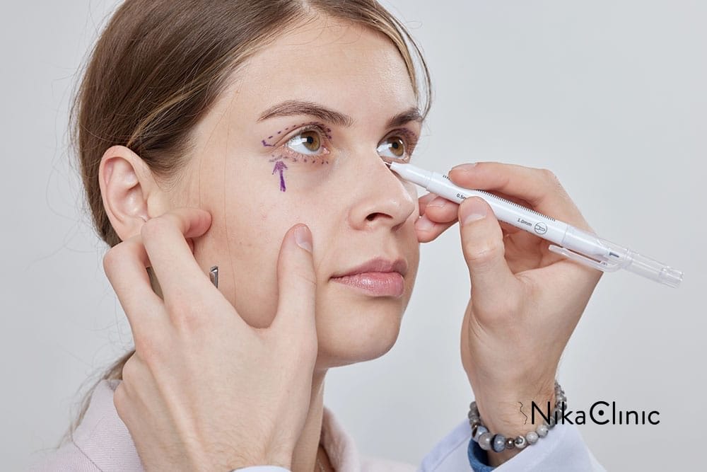 Un medico traccia un segno sotto l'occhio di una donna con una penna, preparandola alla blefaroplastica inferiore per affrontare borse e occhiaie. Intervento chirurgico disponibile presso la Nika Clinic