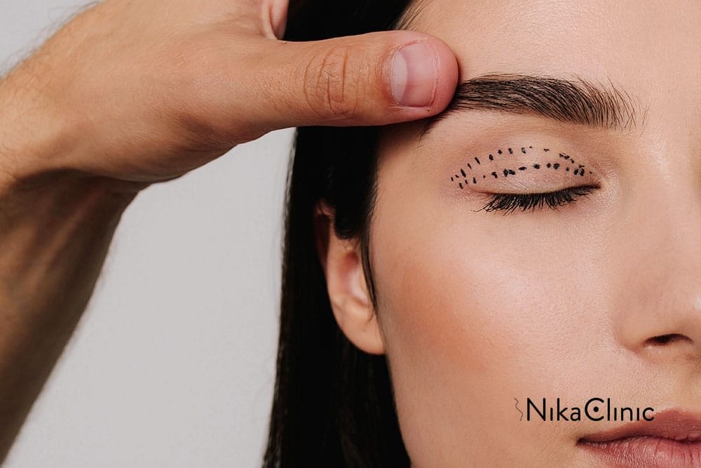 Una mano solleva il sopracciglio di una donna; linee tratteggiate sono segnate sulla palpebra chiusa per la Blefaroplastica Superiore, un intervento di chirurgia estetica progettato per ottenere uno sguardo giovane e aperto. Disponibile presso la Nika Clinic a Milano