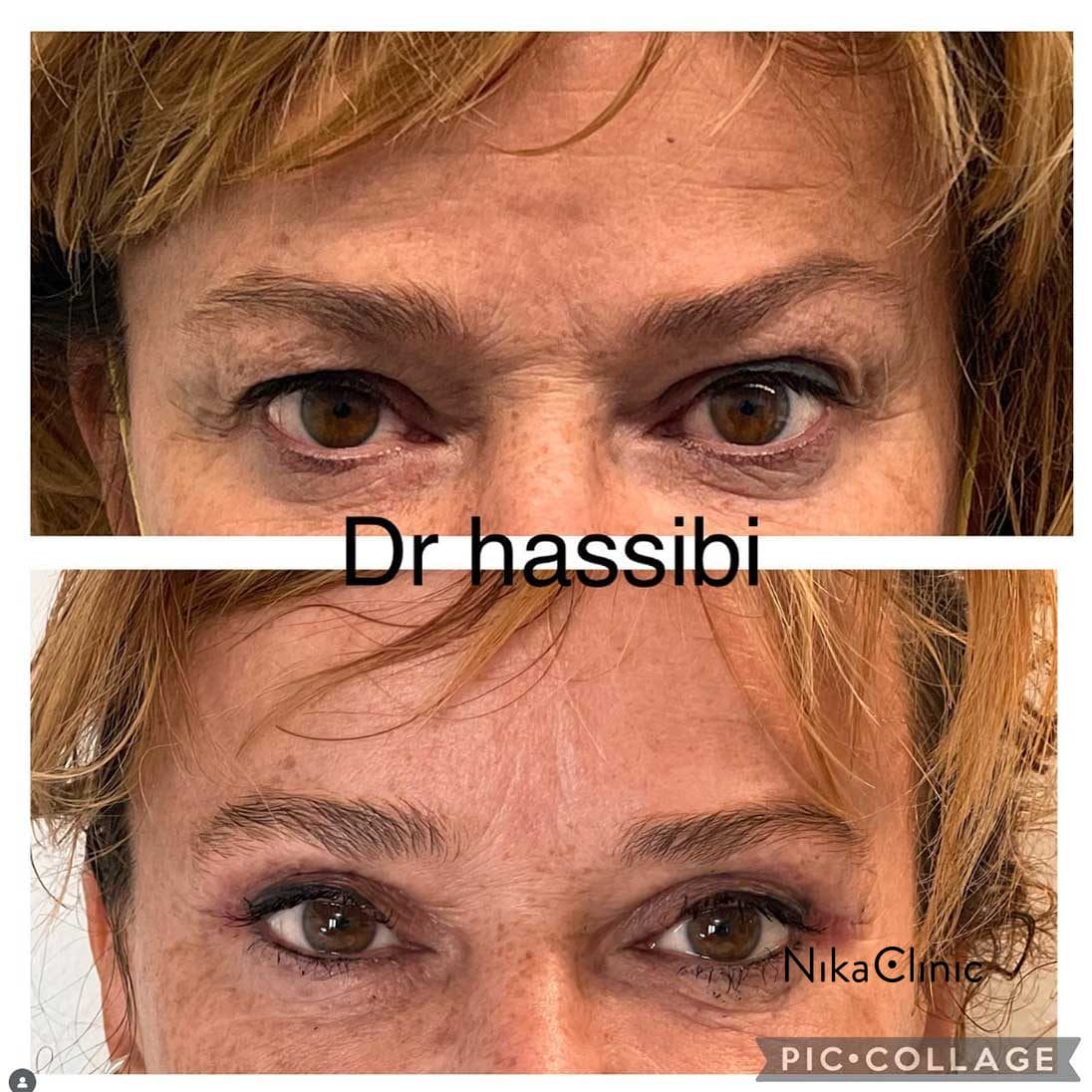 Foto prima e dopo che mostrano una riduzione delle rughe e una pelle più liscia intorno agli occhi di una donna dopo un intervento di Blefaroplastica Superiore, rivelando uno sguardo giovane e aperto.