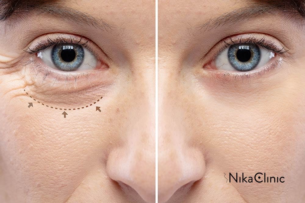 Primo piano degli occhi di una persona che mostra le rughe sotto gli occhi a sinistra e la pelle più liscia a destra dopo la blefaroplastica, evidenziando i risultati visibili nel periodo post operatorio.