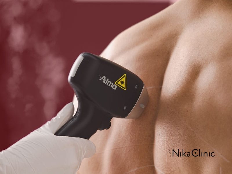Una mano guantata utilizza un dispositivo di epilazione laser SHR Milano sulla schiena nuda di una persona, offrendo un'epilazione definitiva per risultati lisci e duraturi.
