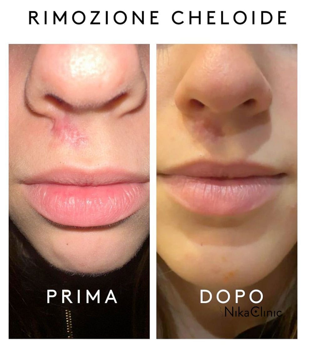 Foto affiancate del labbro superiore e dell'area del naso di una persona etichettate "PRIMA" (prima) con una cicatrice cheloidea e "DOPO" (dopo) con una pelle più liscia. Il testo sopra recita "RIMOZIONE CHELOIDE" e il risultato di un Trattamento Avanzato di Asportazione Cheloidi a Milano.